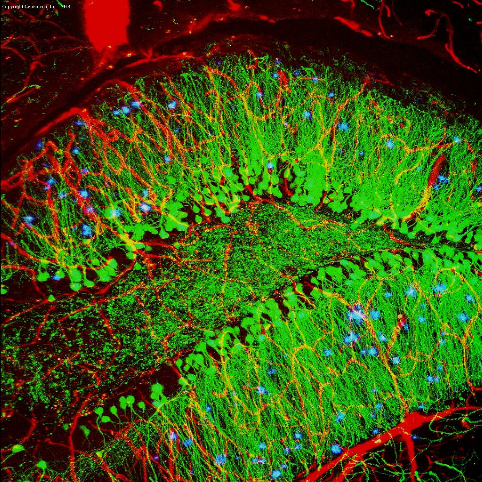 Brain showing hallmarks of Alzheimer’s disease. Credit: Alvin Gogineni, Genentech.